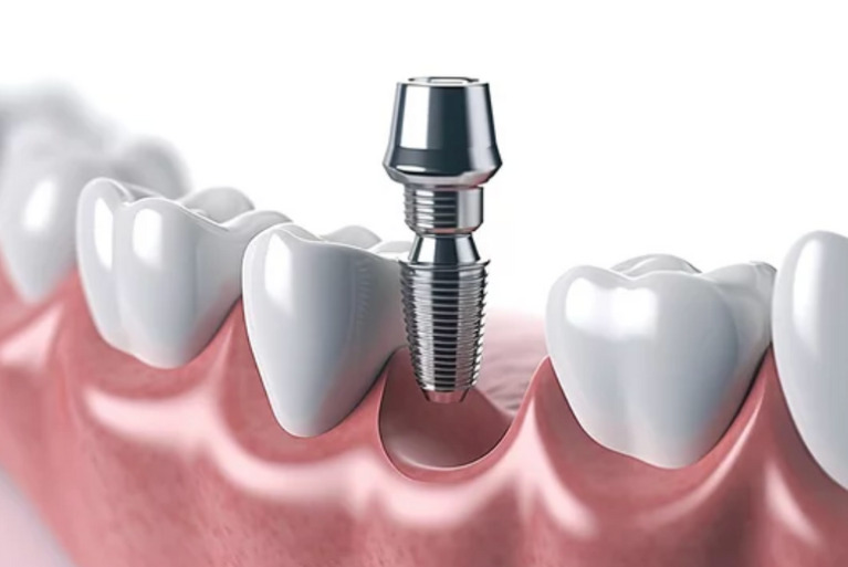 二次手術（二次オペ）