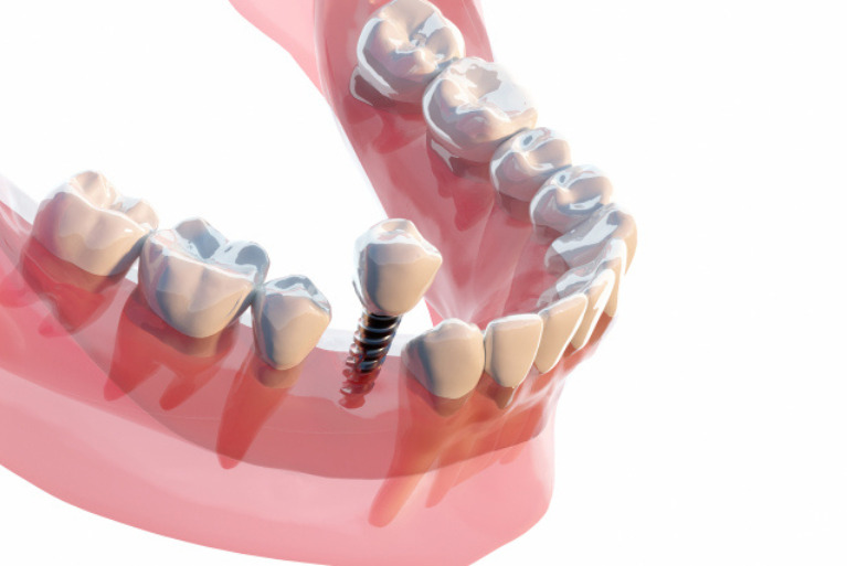 インプラント治療とは