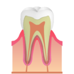 Ce：ごく初期段階の虫歯