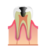 C3：歯の神経やその付近にまで達した虫歯